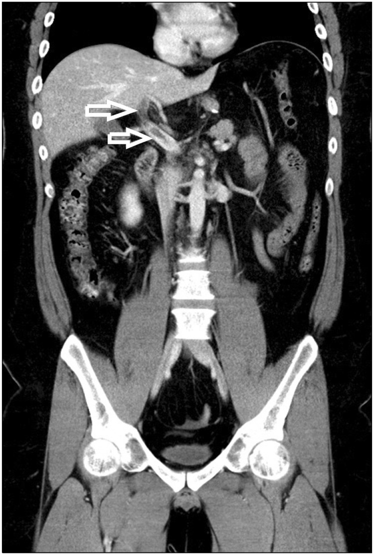 Portomesenteric Vein Thrombosis after Laparoscopic Sleeve Gastrectomy: A Case Report.