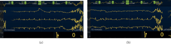 High Incidence of Burst Suppression during Propofol Sedation for Outpatient Colonoscopy: Lessons Learned from Neuromonitoring.