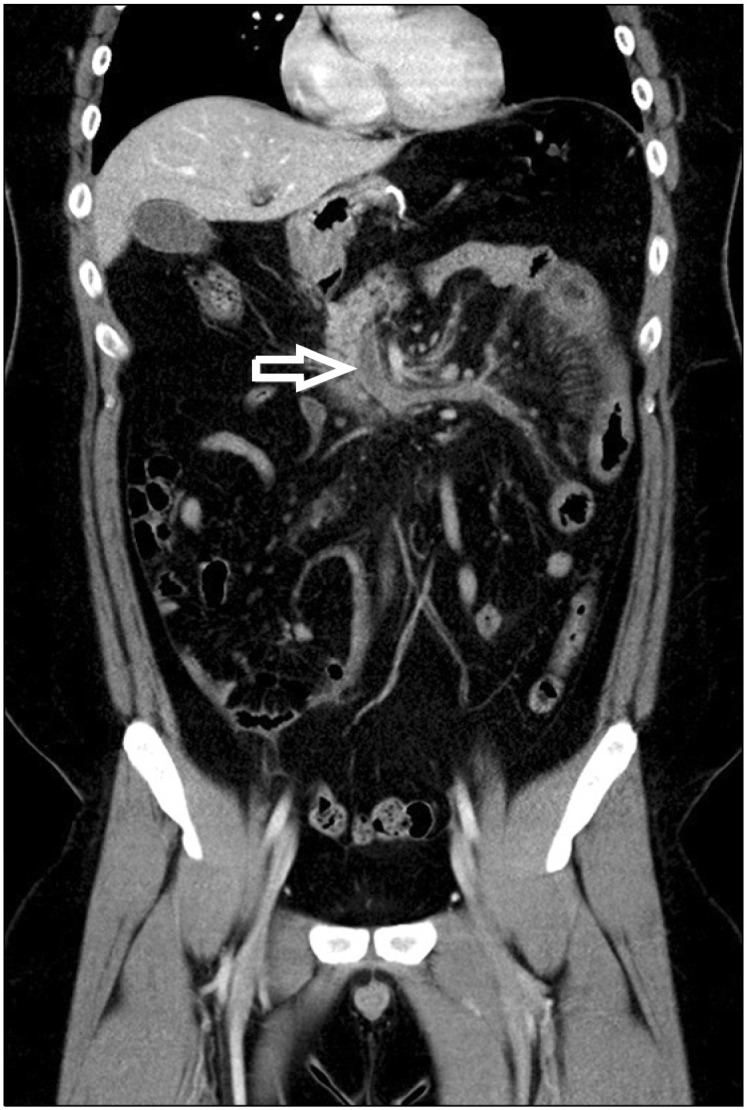 Portomesenteric Vein Thrombosis after Laparoscopic Sleeve Gastrectomy: A Case Report.