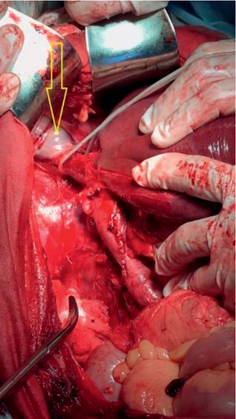 Removal of the Tumor Thrombus from the Right Atrium without Extracorporeal Circulation: Emphasis on the Displacement of the Tumor Apex.