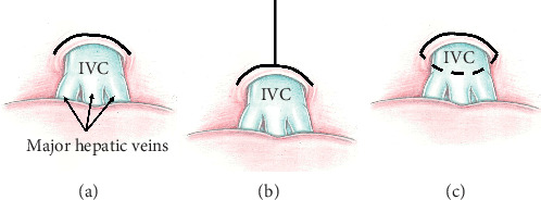 Removal of the Tumor Thrombus from the Right Atrium without Extracorporeal Circulation: Emphasis on the Displacement of the Tumor Apex.