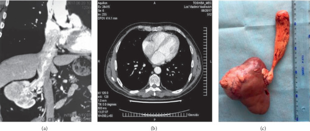 Removal of the Tumor Thrombus from the Right Atrium without Extracorporeal Circulation: Emphasis on the Displacement of the Tumor Apex.