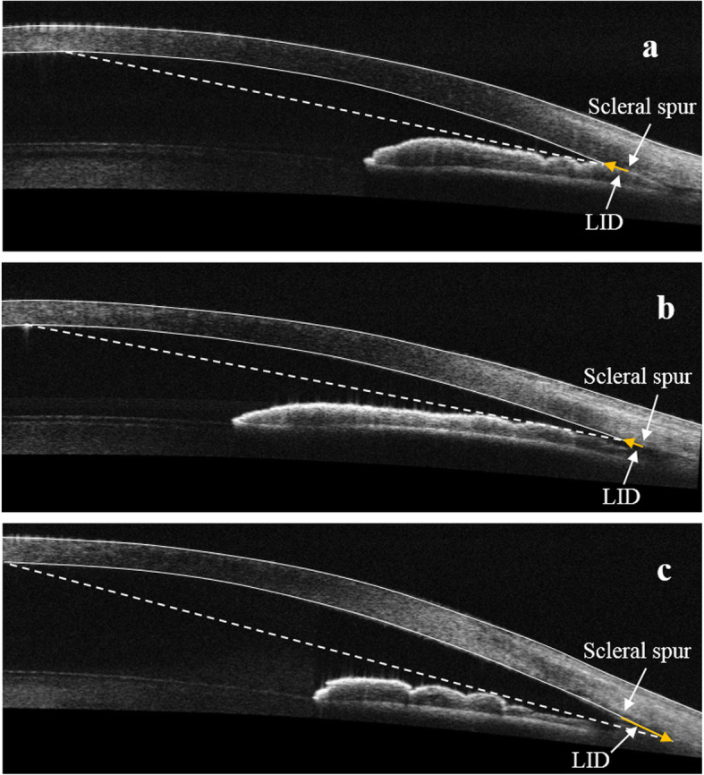 Modeling of gonioscopic anterior chamber angle grades based on anterior segment optical coherence tomography.