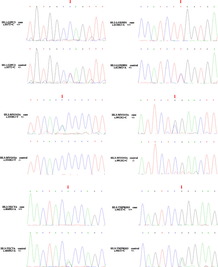 Whole exome sequencing identified mutations causing hearing loss in five consanguineous Pakistani families.