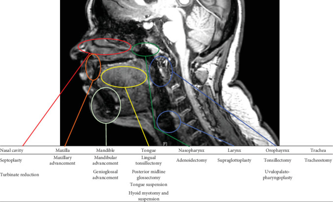 Alternative Approaches to Adenotonsillectomy and Continuous Positive Airway Pressure (CPAP) for the Management of Pediatric Obstructive Sleep Apnea (OSA): A Review.