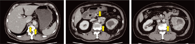 A Case of Metastatic Hereditary Leiomyomatosis and Renal Cell Cancer Syndrome-Associated Renal Cell Carcinoma Treated with a Sequence of Axitinib and Nivolumab Following Cytoreductive Nephrectomy.