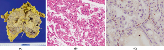 A Case of Metastatic Hereditary Leiomyomatosis and Renal Cell Cancer Syndrome-Associated Renal Cell Carcinoma Treated with a Sequence of Axitinib and Nivolumab Following Cytoreductive Nephrectomy.