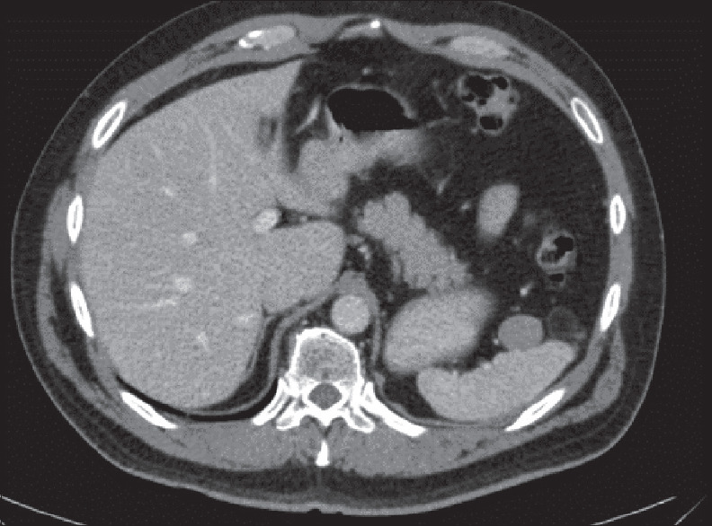 Desmoid-type Fibromatosis of the Splenic Hilum: A Rare Tumor at an Unusual Location.