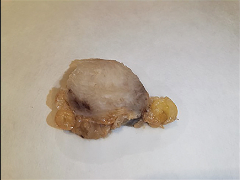 Desmoid-type Fibromatosis of the Splenic Hilum: A Rare Tumor at an Unusual Location.