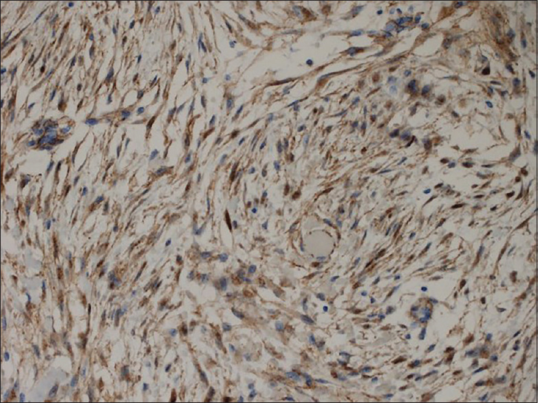 Desmoid-type Fibromatosis of the Splenic Hilum: A Rare Tumor at an Unusual Location.