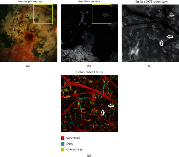 OCT Angiography and En Face OCT Reflectance Aid in Monitoring Subclinical Inflammation in Serpiginous Choroidopathy.