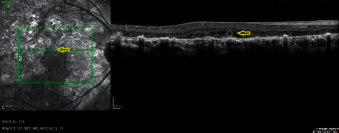 OCT Angiography and En Face OCT Reflectance Aid in Monitoring Subclinical Inflammation in Serpiginous Choroidopathy.