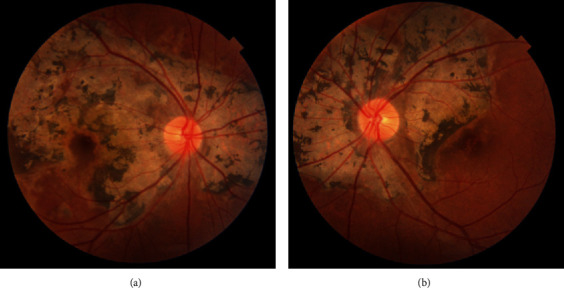 OCT Angiography and En Face OCT Reflectance Aid in Monitoring Subclinical Inflammation in Serpiginous Choroidopathy.