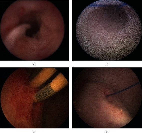 Histological Inflammation in Human Ureter either Healthy or Fitted with Double-Pigtail Stent or a Thin 0.3 F Suture Thread: A Preliminary Study.