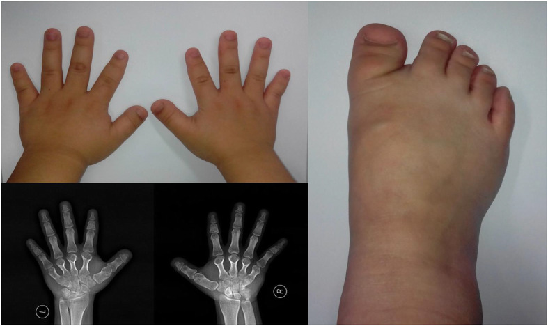 Whole-exome sequencing identifies a de novo PDE3A variant causing autosomal dominant hypertension with brachydactyly type E syndrome: a case report.