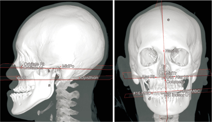 Three-dimensional evaluation of the correlation between lip canting and craniofacial planes.