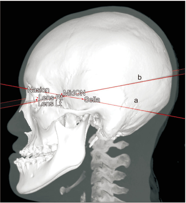 Three-dimensional evaluation of the correlation between lip canting and craniofacial planes.