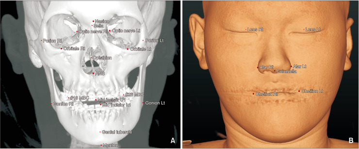 Three-dimensional evaluation of the correlation between lip canting and craniofacial planes.