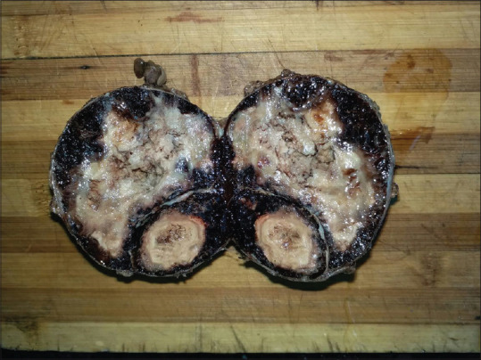 Cavernous Hemangioma of the Adrenal Gland: A Rare Adrenal Incidentaloma.