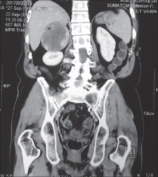 Cavernous Hemangioma of the Adrenal Gland: A Rare Adrenal Incidentaloma.