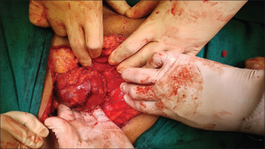 Cavernous Hemangioma of the Adrenal Gland: A Rare Adrenal Incidentaloma.