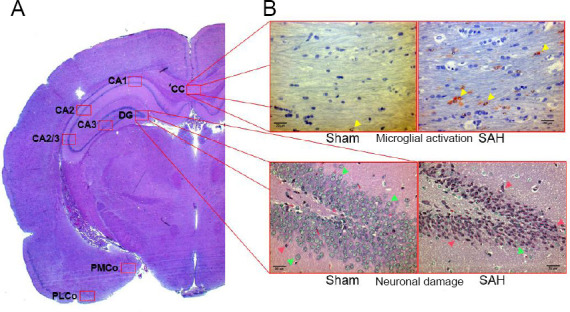 Argon treatment after experimental subarachnoid hemorrhage: evaluation of microglial activation and neuronal survival as a subanalysis of a randomized controlled animal trial.