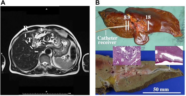 In Vitro Intraductal MRI and T2 Mapping of Cholangiocarcinoma Using Catheter Coils.