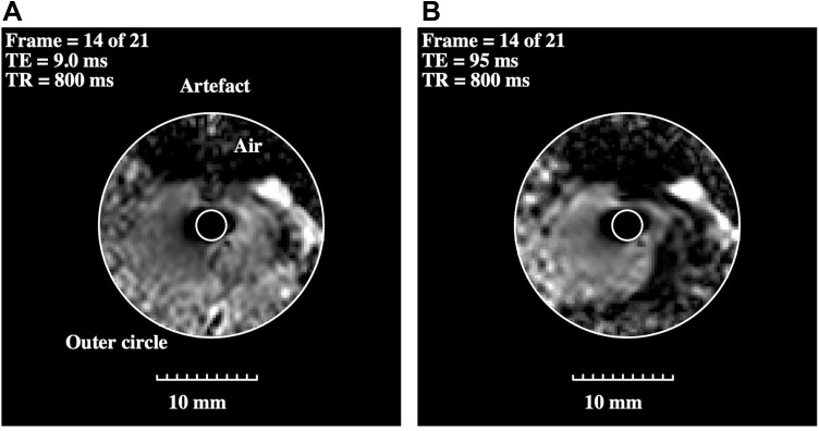 In Vitro Intraductal MRI and T2 Mapping of Cholangiocarcinoma Using Catheter Coils.