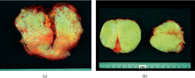 The Management of Desmoid Tumors: A Retrospective Study of 30 Cases.