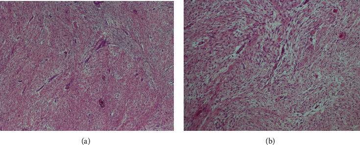 The Management of Desmoid Tumors: A Retrospective Study of 30 Cases.