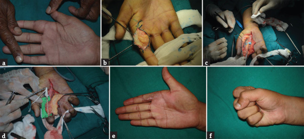 Fibrolipomatous Hamartoma of the Median Nerve: An Outcome of Surgical Management in Six Consecutive Cases.