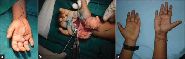 Fibrolipomatous Hamartoma of the Median Nerve: An Outcome of Surgical Management in Six Consecutive Cases.