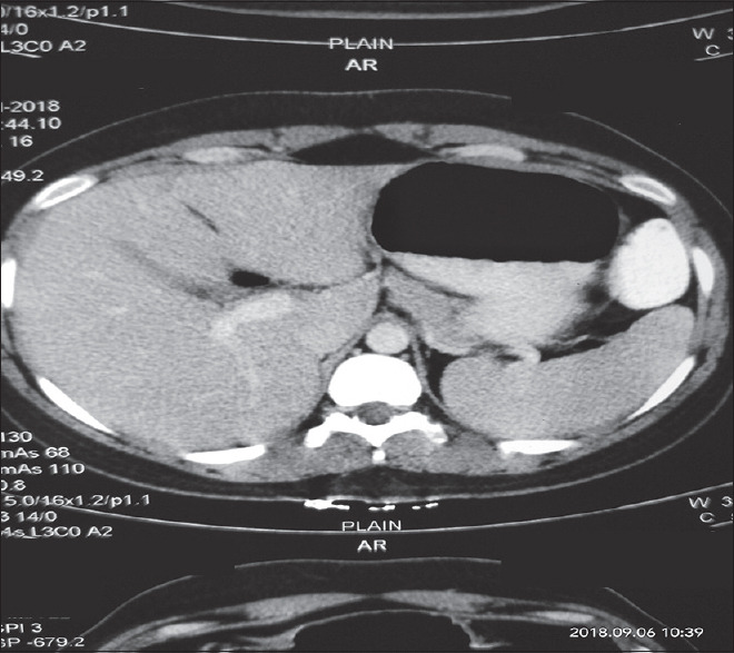 Gastric Glomus Tumor.