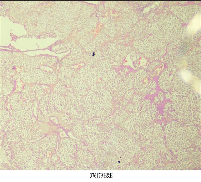 Gastric Glomus Tumor.