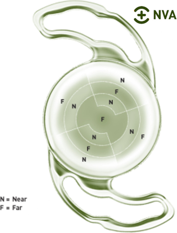 Clinical outcomes with a new design in multifocal intraocular lens: a pilot study.
