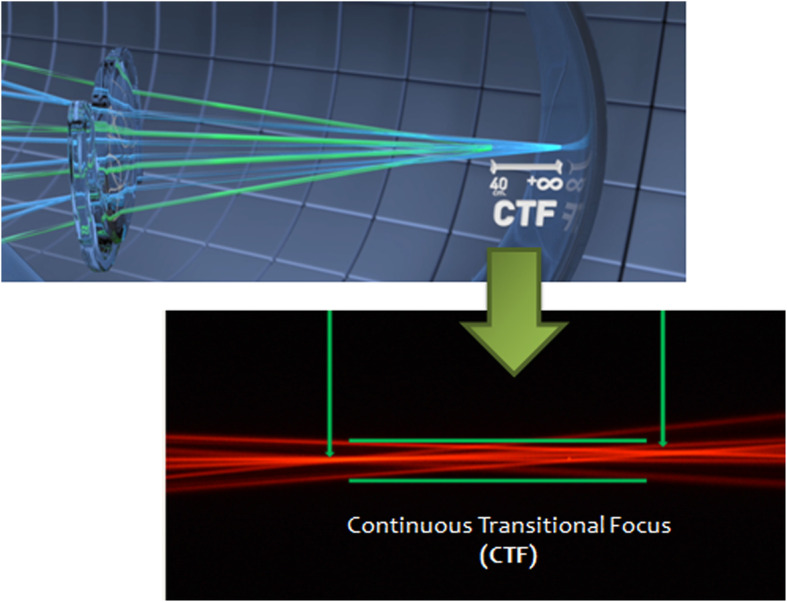 Clinical outcomes with a new design in multifocal intraocular lens: a pilot study.