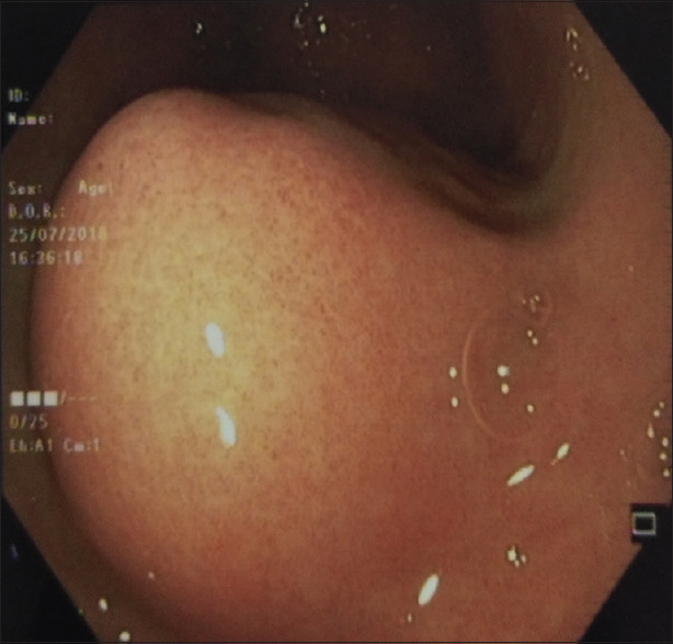Gastric Glomus Tumor.