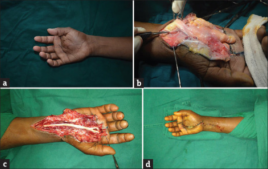 Fibrolipomatous Hamartoma of the Median Nerve: An Outcome of Surgical Management in Six Consecutive Cases.