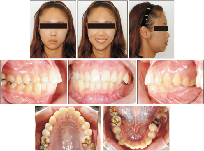 Camouflage treatment of posterior bite collapse in a patient with skeletal asymmetry by using posterior maxillary segmental osteotomy.