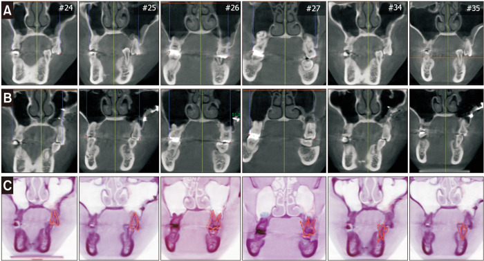 Camouflage treatment of posterior bite collapse in a patient with skeletal asymmetry by using posterior maxillary segmental osteotomy.