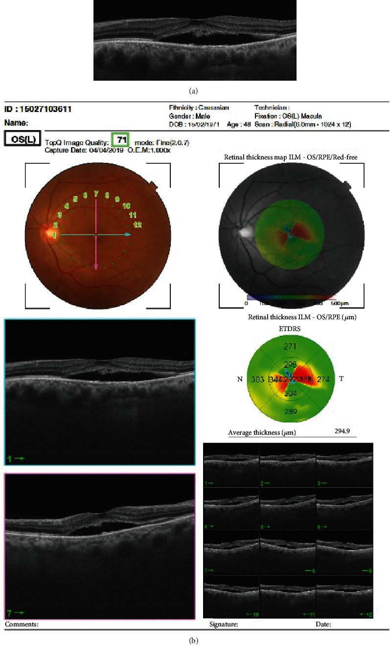 Keratoconus with Central Serous Chorioretinopathy: A Rare Combination.