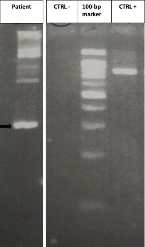 Sorafenib Induced Complete Cytogenetic and Molecular Response in a Chronic Eosinophilic Leukemia Case with t(12;13) Translocation.