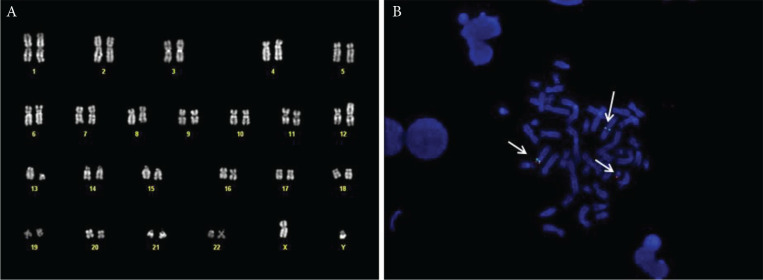 Sorafenib Induced Complete Cytogenetic and Molecular Response in a Chronic Eosinophilic Leukemia Case with t(12;13) Translocation.