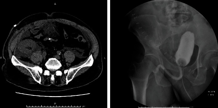 Effectiveness of Factor XIII Infusion in Treatment of Refractory Ureteral Leakage after Kidney Transplantation.