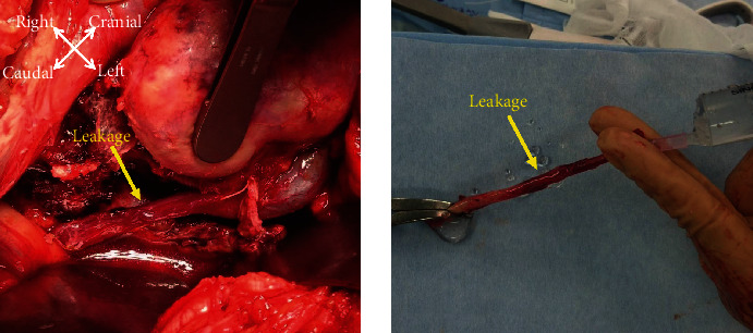 Effectiveness of Factor XIII Infusion in Treatment of Refractory Ureteral Leakage after Kidney Transplantation.