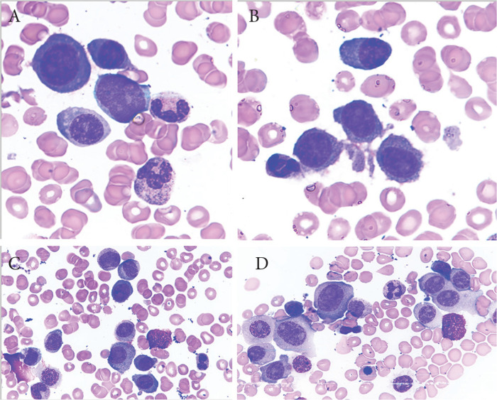 Plasma Cell Leukemia - Facts and Controversies: More Questions than Answers?