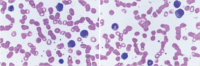 Plasma Cell Leukemia - Facts and Controversies: More Questions than Answers?