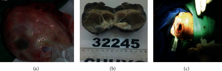 Prenatal Exophthalmia Revealing a Postnatal Orbital Teratoma.