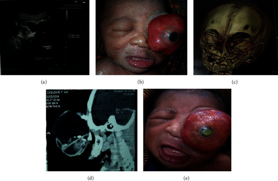 Prenatal Exophthalmia Revealing a Postnatal Orbital Teratoma.