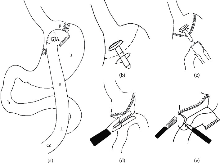 Linear versus Circular Stapler for Gastrojejunal Anastomosis in Laparoscopic Roux-En-Y Gastric Bypass: An Analysis of 211 Cases.